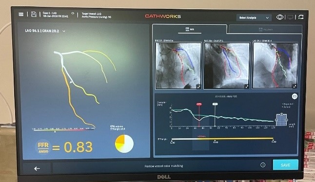 The CathWorks FFRangio® System uses computational science to visualize a patient’s heart.