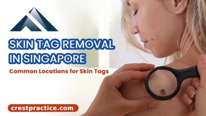Skin tag removal Singapore