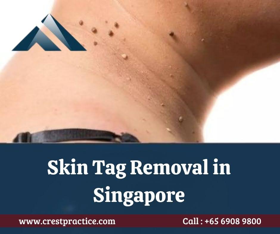 skin tag removal in Singapore